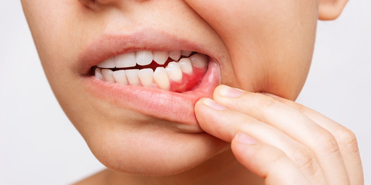 Gum Disease Prevention and Awareness - Newton Dental Studio