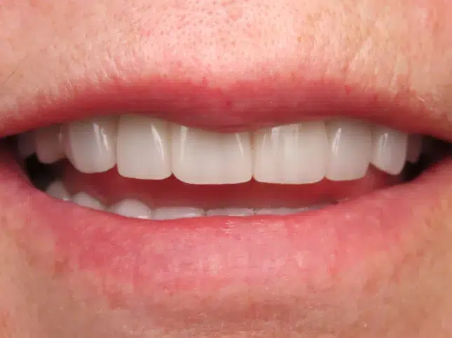 After teeth whitening in Newton KS - Newton Dental Studio