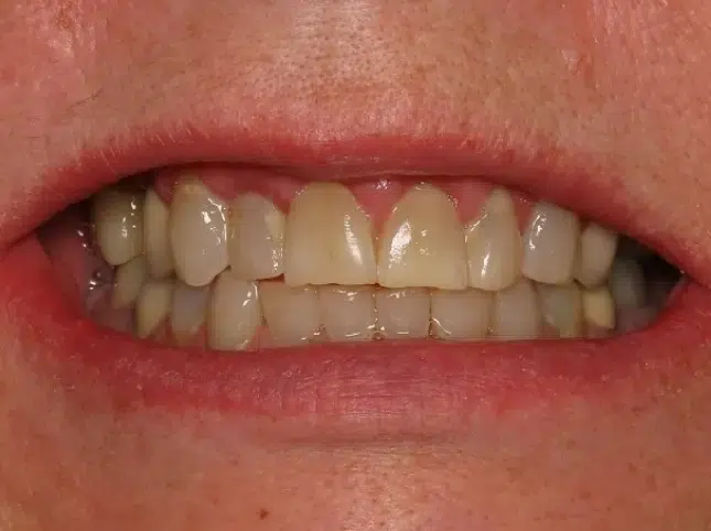 Before teeth whitening in Newton KS - Newton Dental Studio