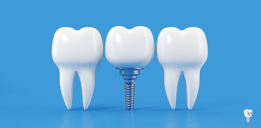 The Complete Guide to Dental Implants