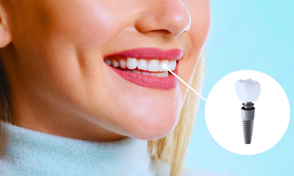 Are You a Candidate for Dental Implants