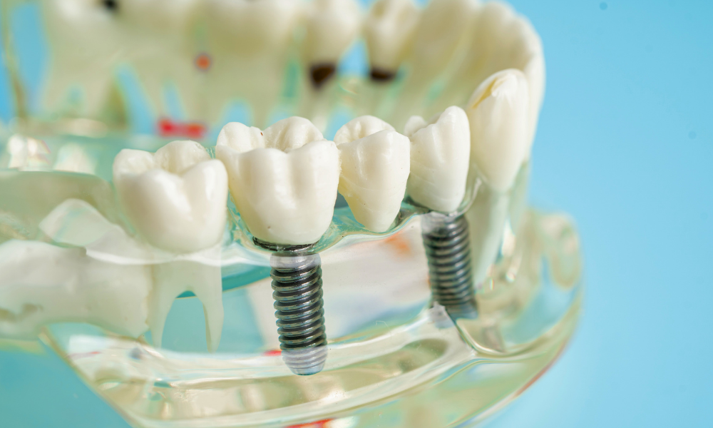 Common Myths About Dental Implants Debunked