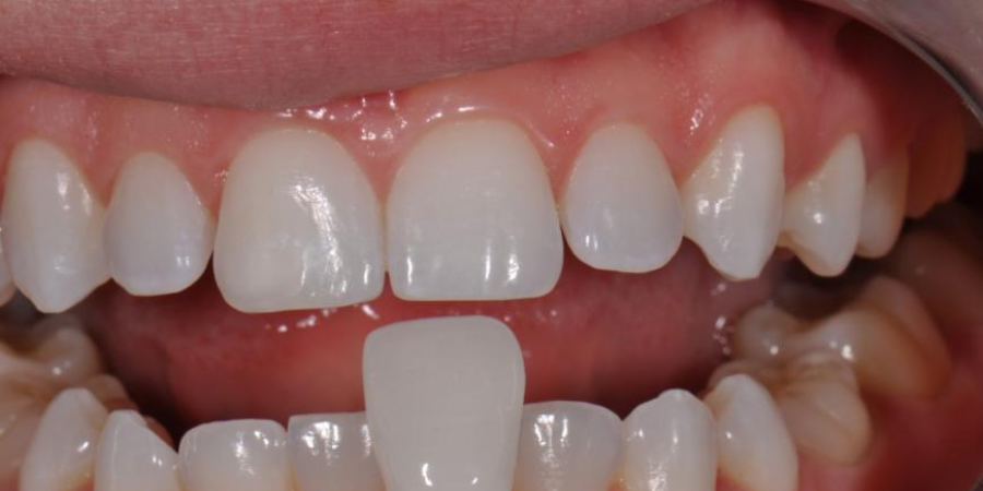 How to Care for Your Porcelain Veneers Tips for Keeping Them Looking New
