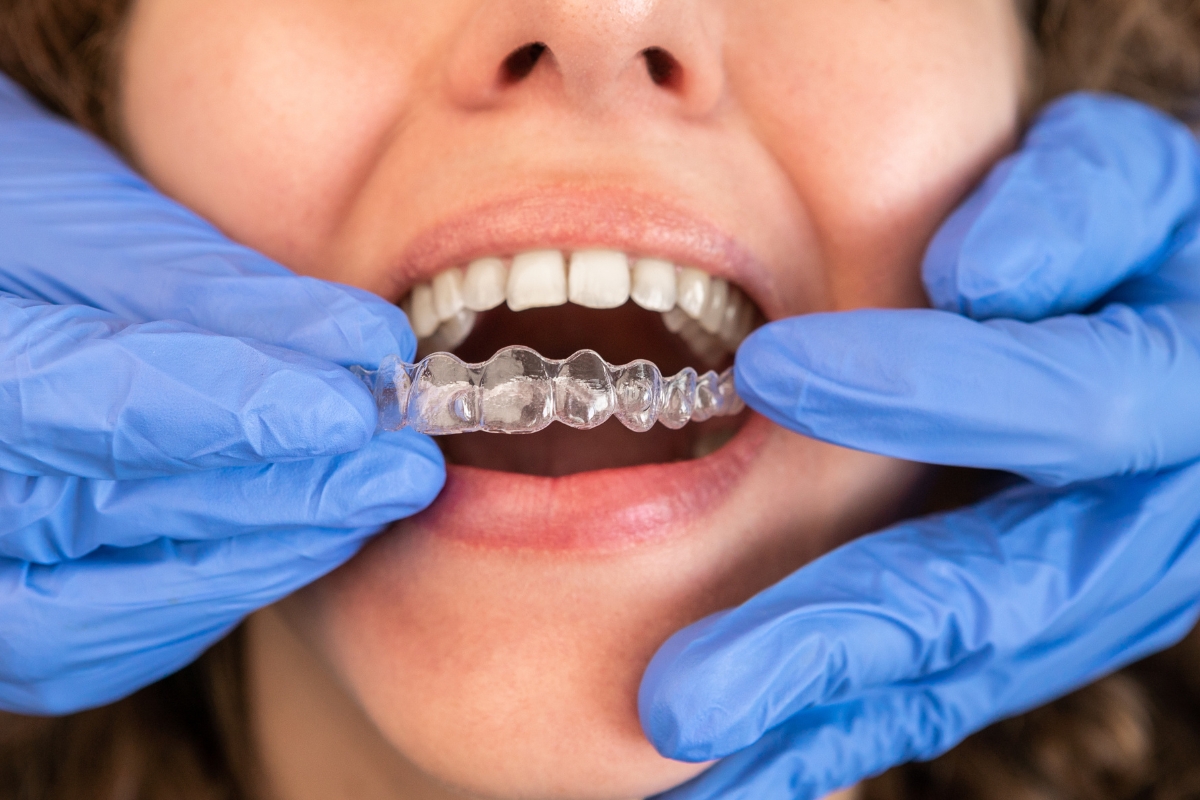 clear aligners in newton