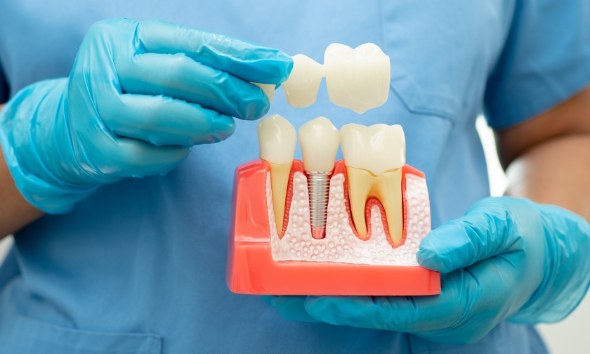 care for dental implants for longevity