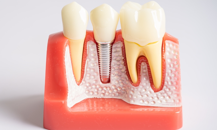 dental implants process in newton
