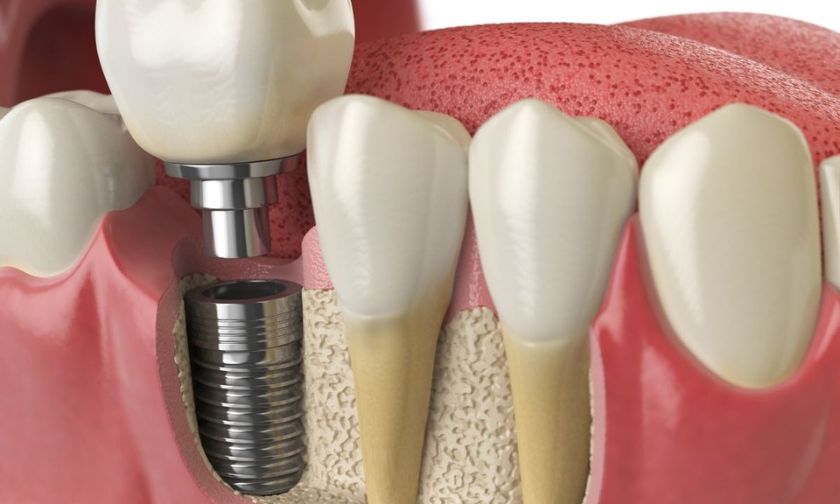dental implants in newton