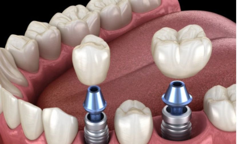 Can You Get Dental Implants If You Have Autoimmune Conditions Like Lupus or Rheumatoid Arthritis?