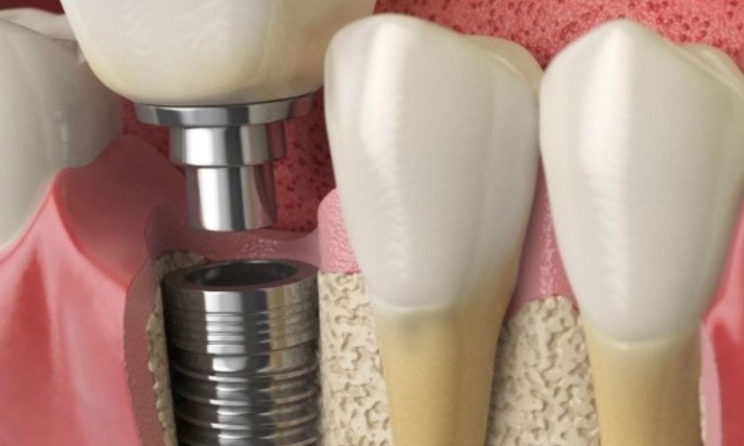 Why Gum Disease Has to Be Treated Before Your Dental Implant and How Newton Dental Studio Does It