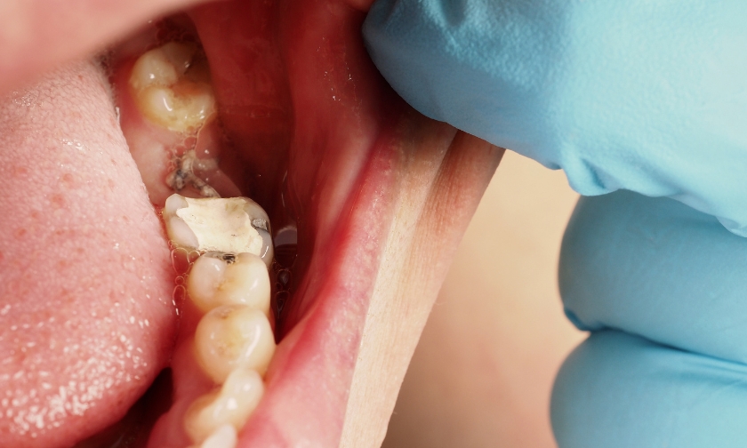 Is There a Connection Between Dry Mouth and Tooth Decay?