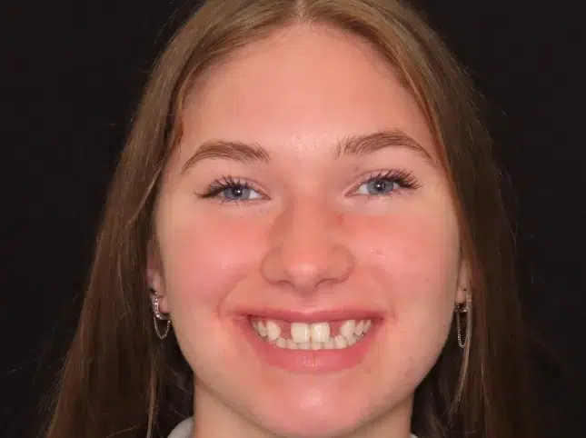 Periodontal Therapy in Newton